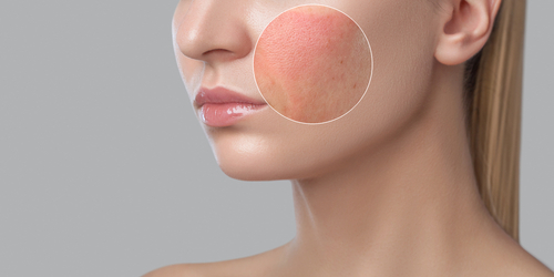 Dermatology Skin rash on womans face