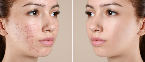 Acne on teenager's face